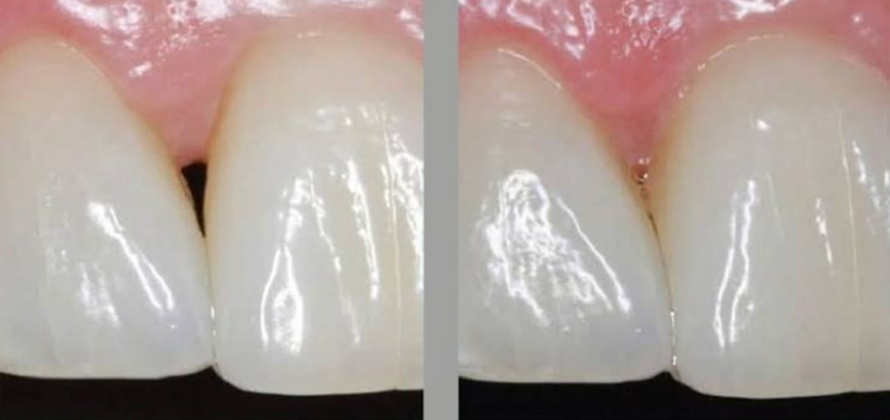 Before and after Gum Builder: the dark triangle between two front teeth is filled in