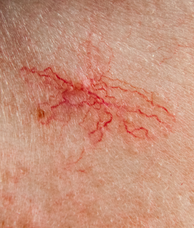 Photo of a vascular lesion