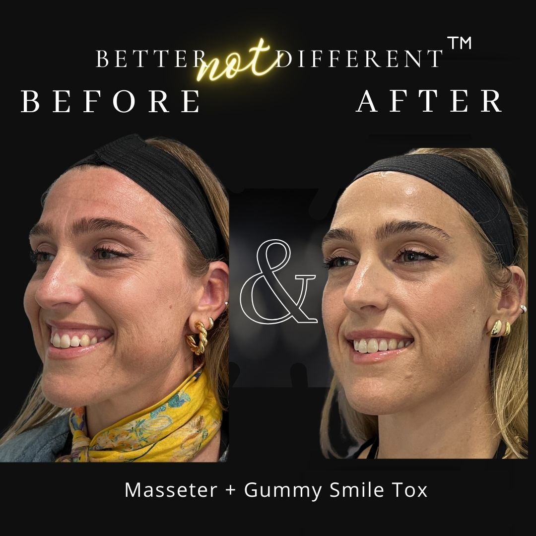Before and after Botox results