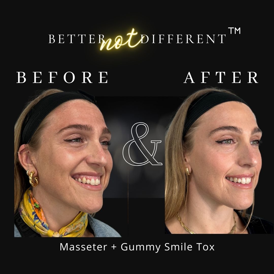 Before and after Botox results
