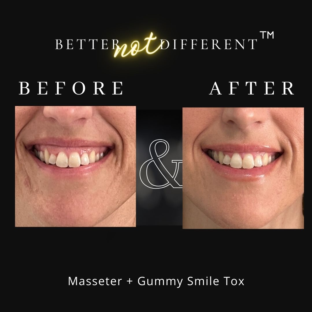 Before and after Botox results