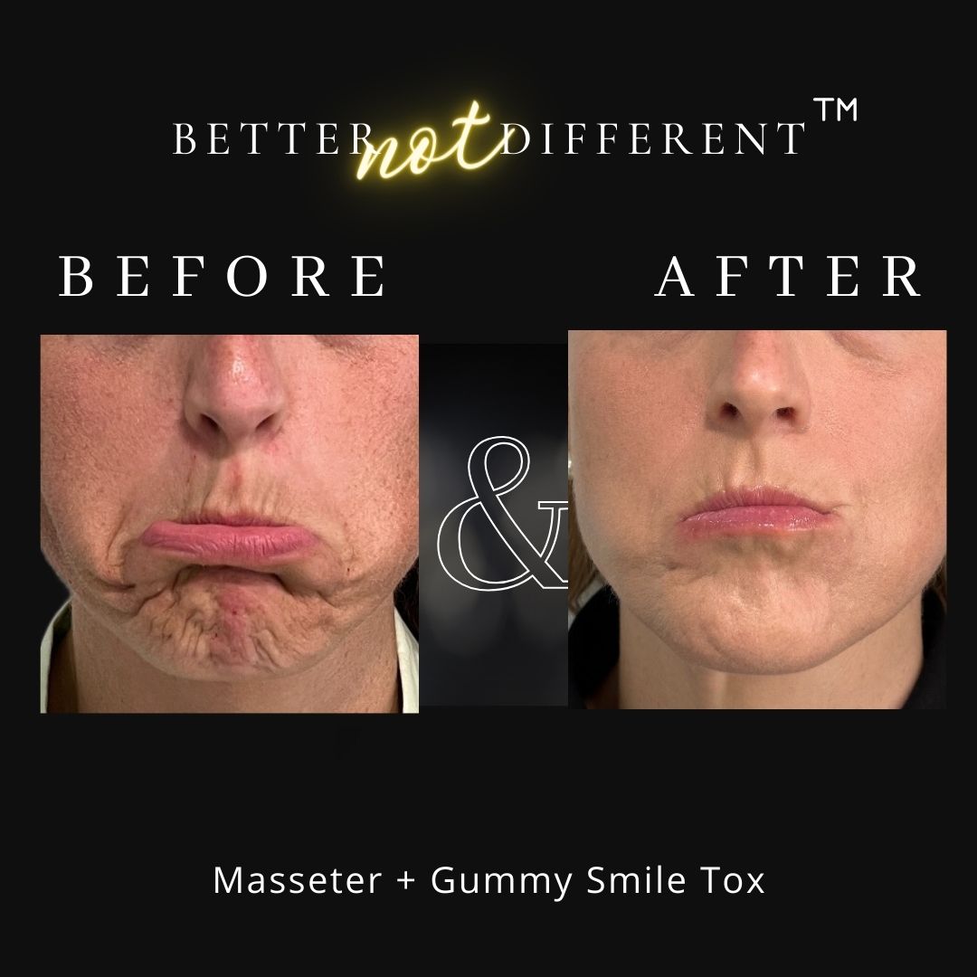 Before and after Botox results