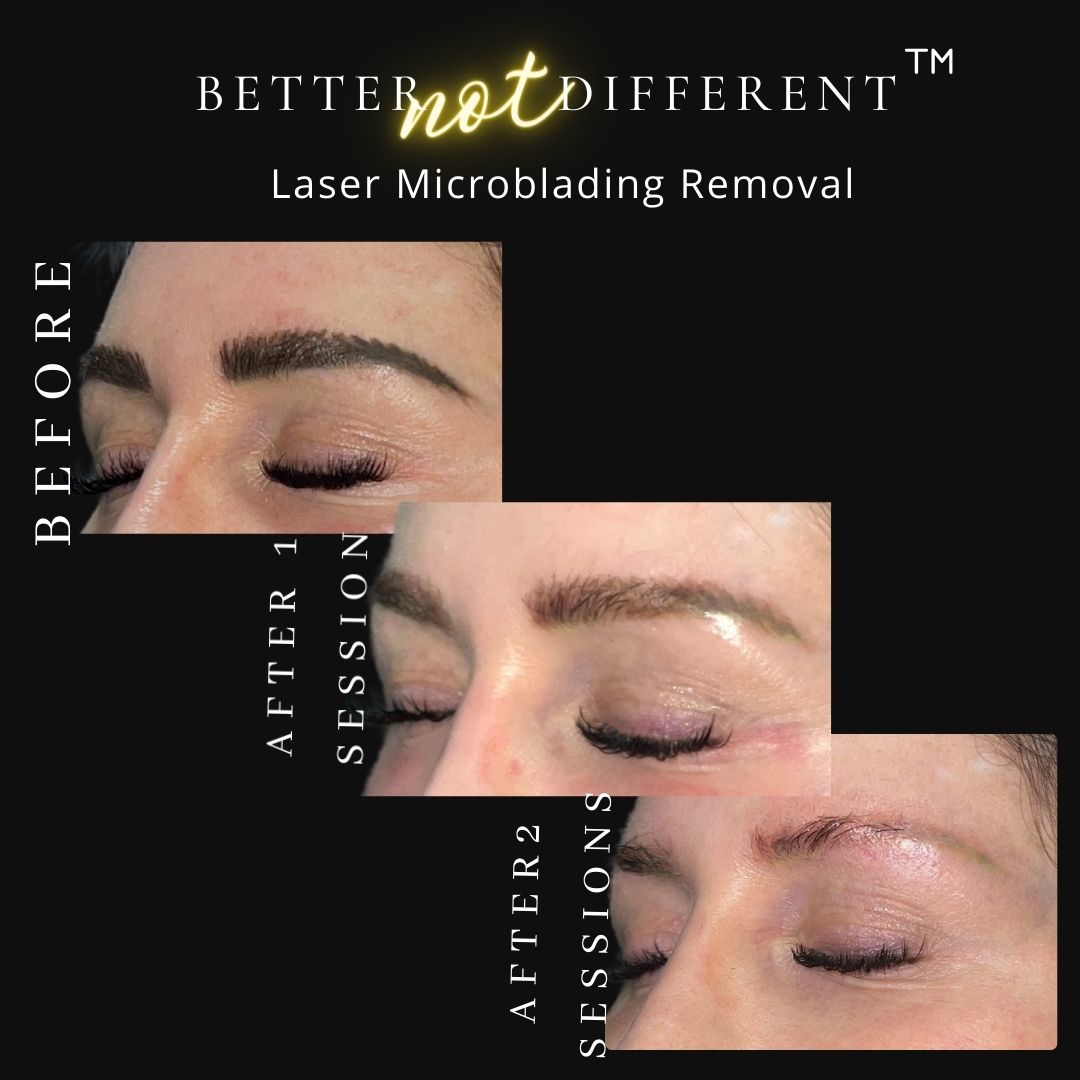 Before and after laser microblading tattoo removal