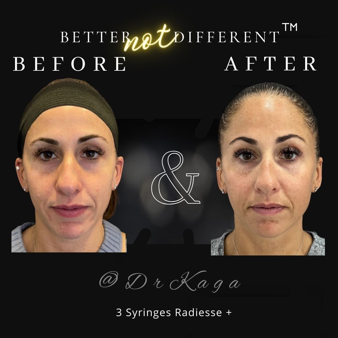 Before and after dermal filler results with Radiesse