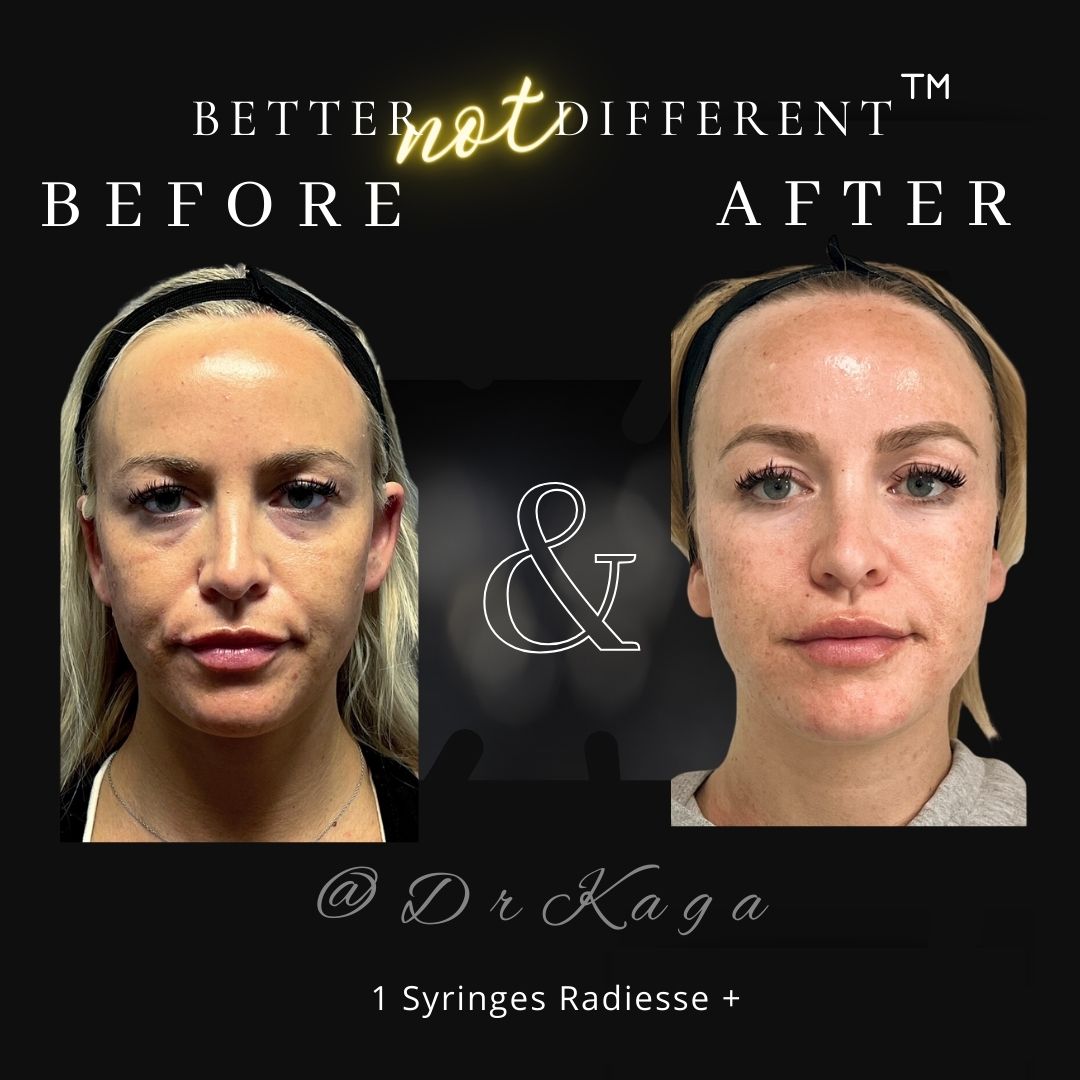 Before and after dermal filler results with Radiesse