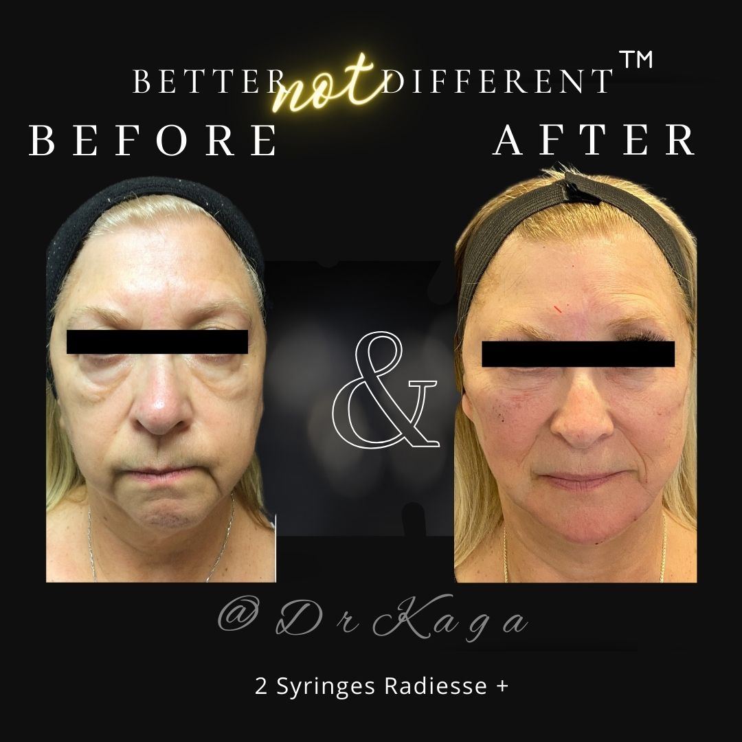 Before and after dermal filler results with Radiesse
