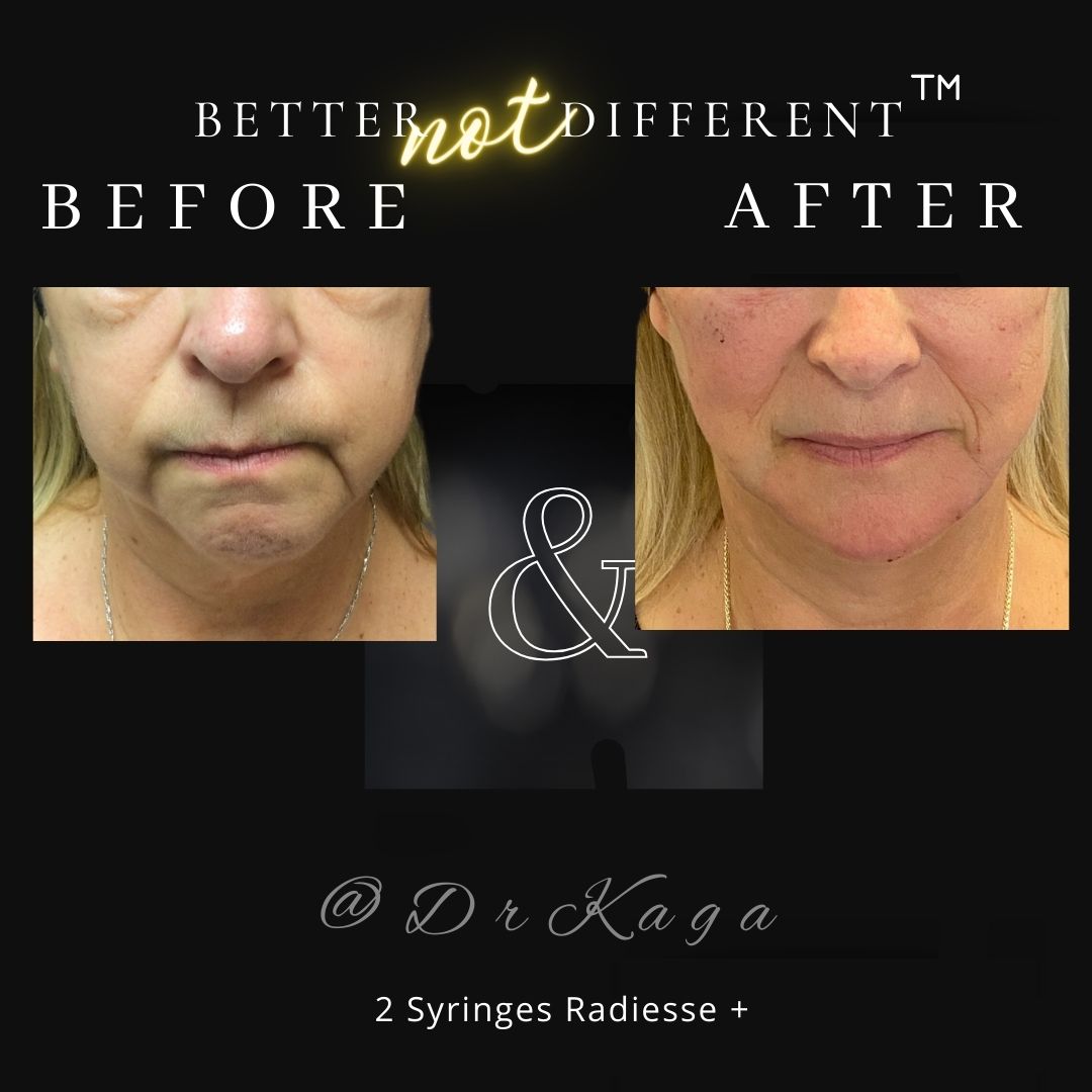 Before and after dermal filler results with Radiesse