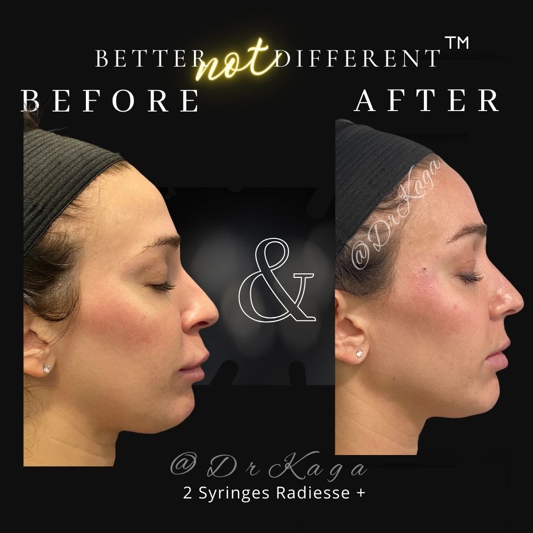 Before and after dermal filler results with Radiesse