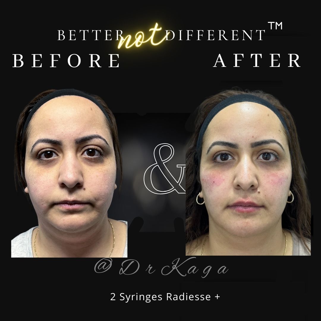 Before and after dermal filler results with Radiesse