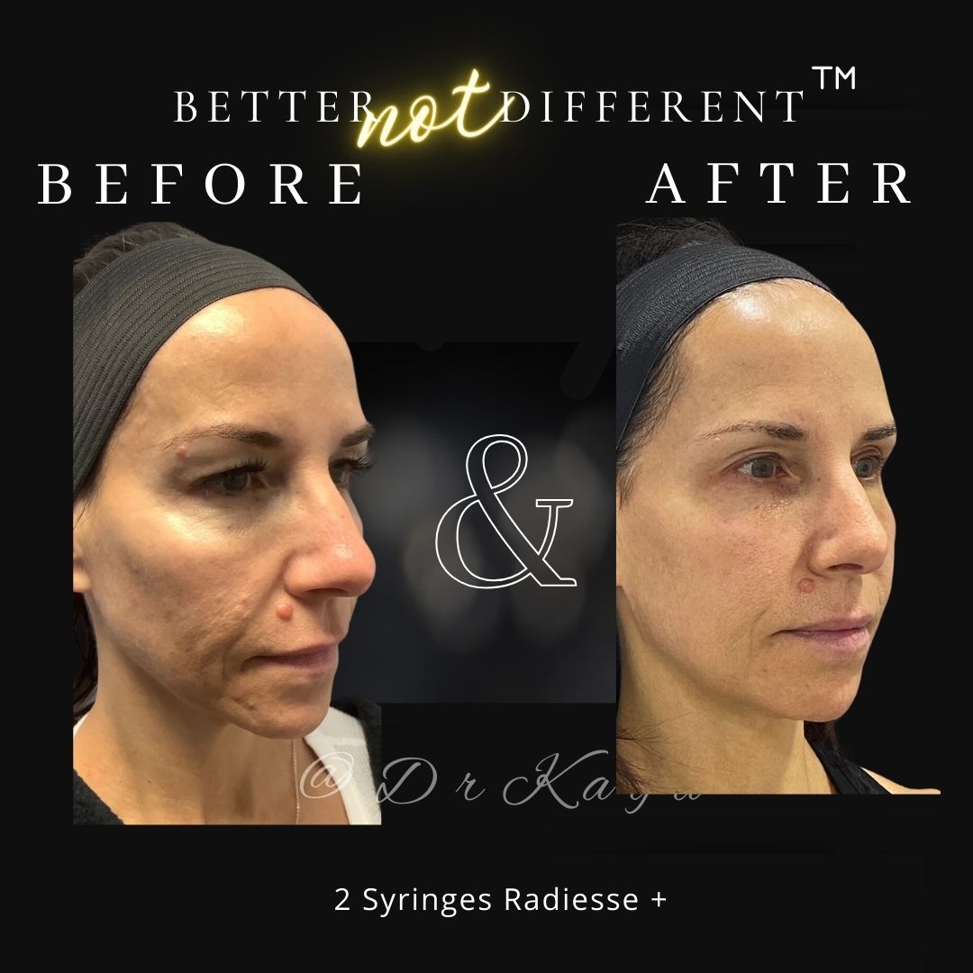 Before and after dermal filler results with Radiesse