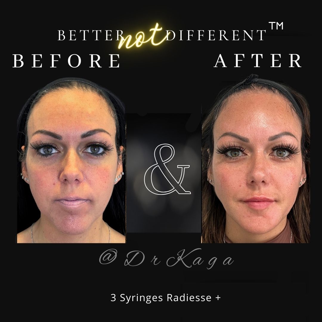 Before and after dermal filler results with Radiesse