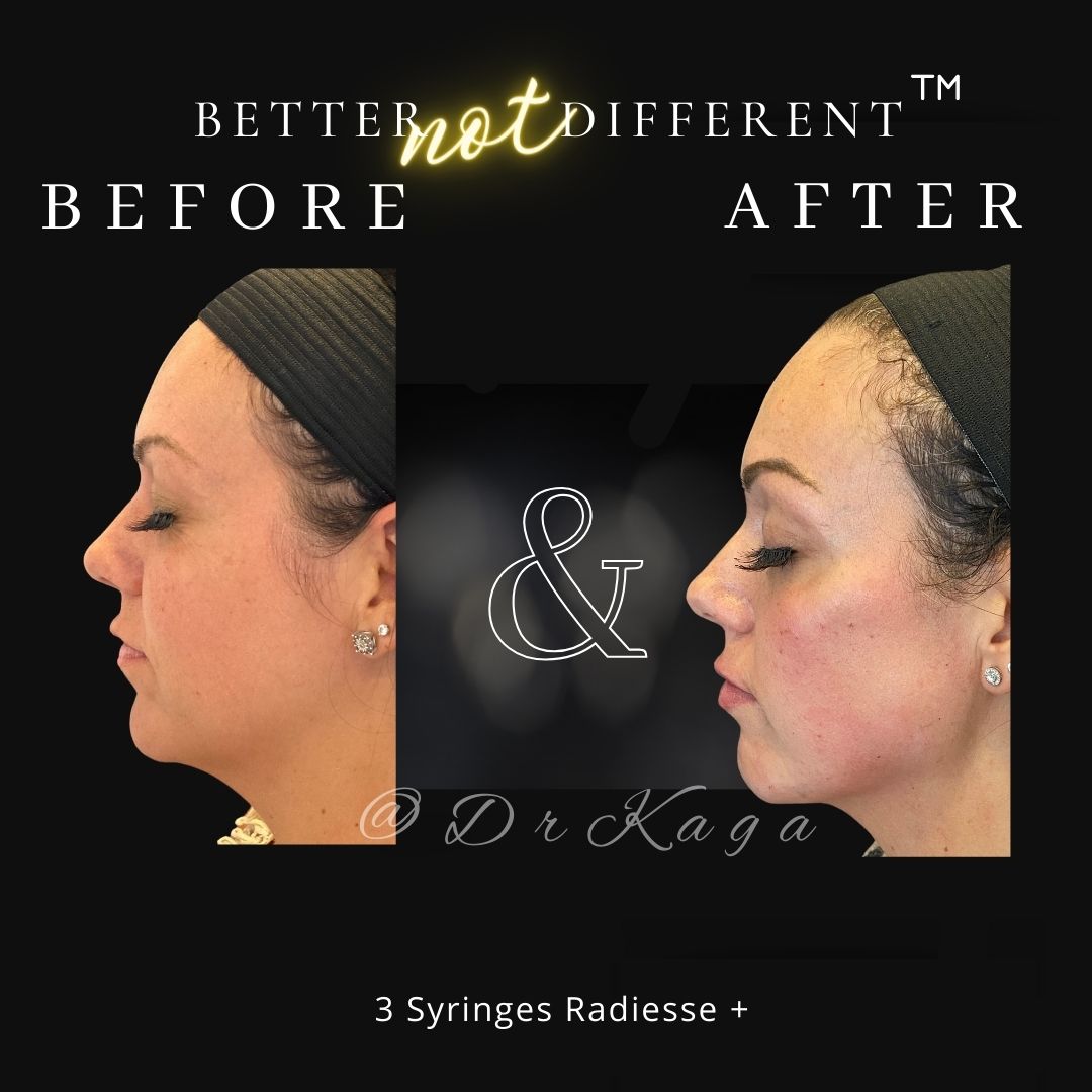 Before and after dermal filler results with Radiesse