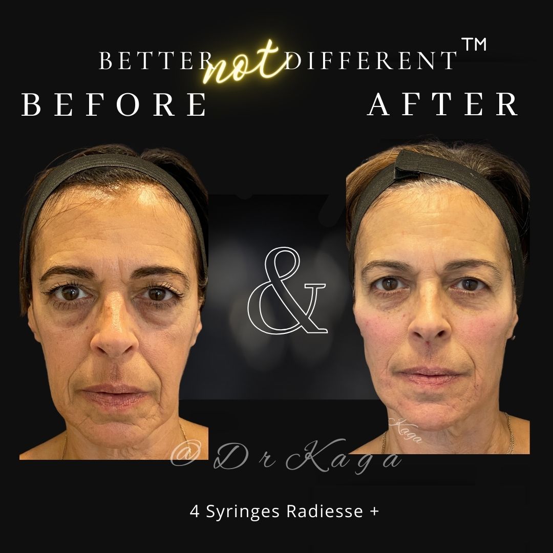 Before and after dermal filler results with Radiesse