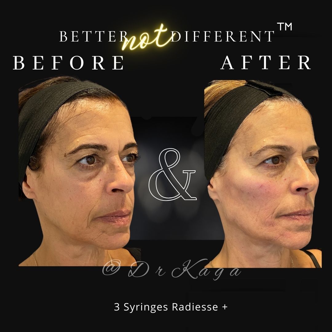 Before and after dermal filler results with Radiesse