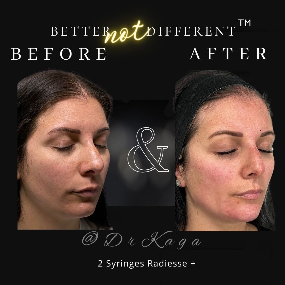 Before and after dermal filler results with Radiesse