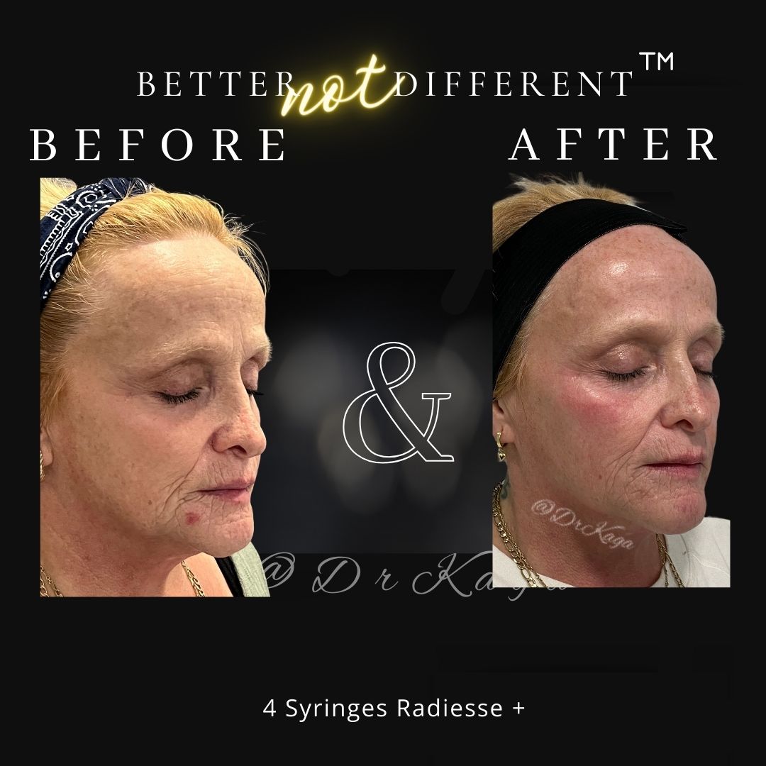 Before and after dermal filler results with Radiesse
