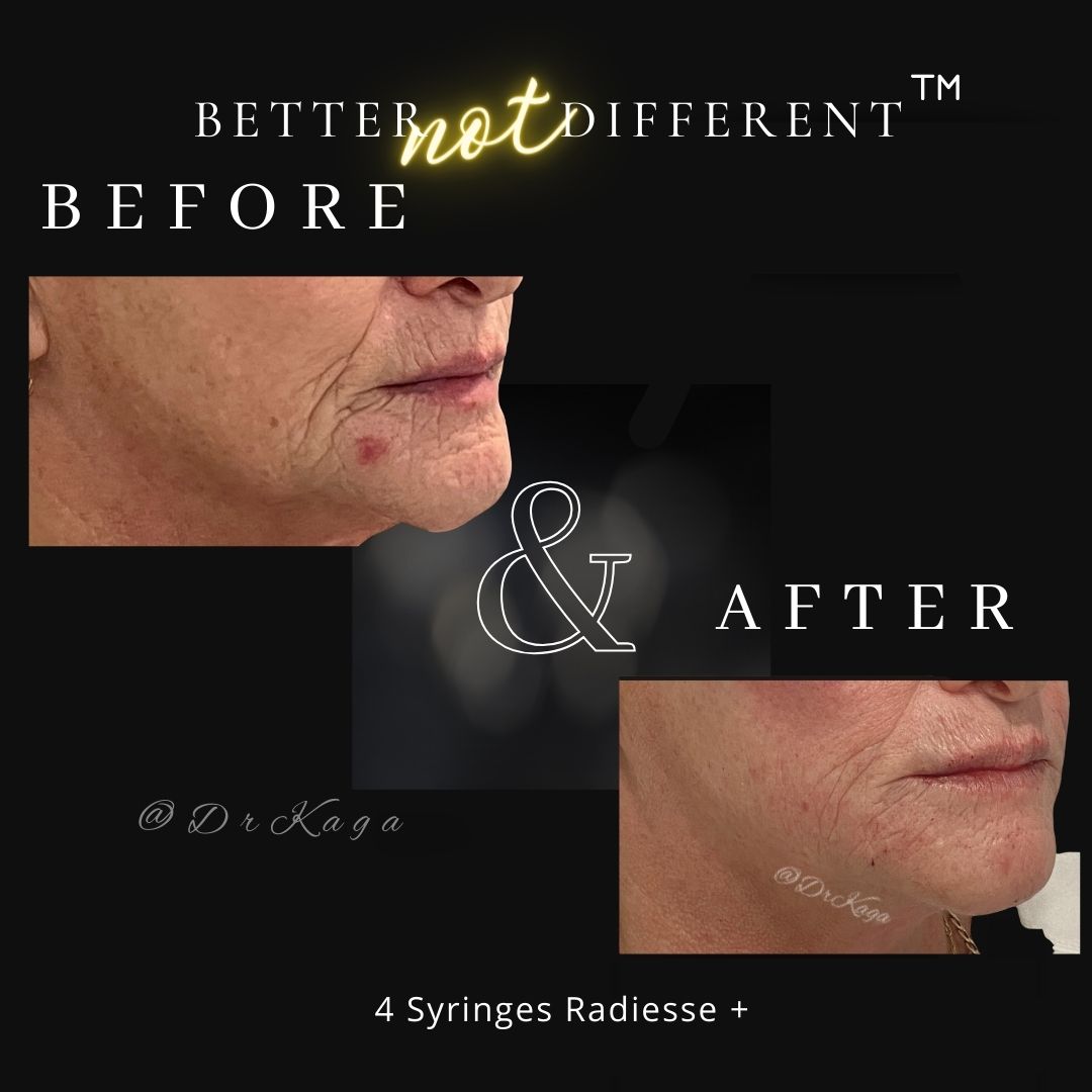 Before and after dermal filler results with Radiesse
