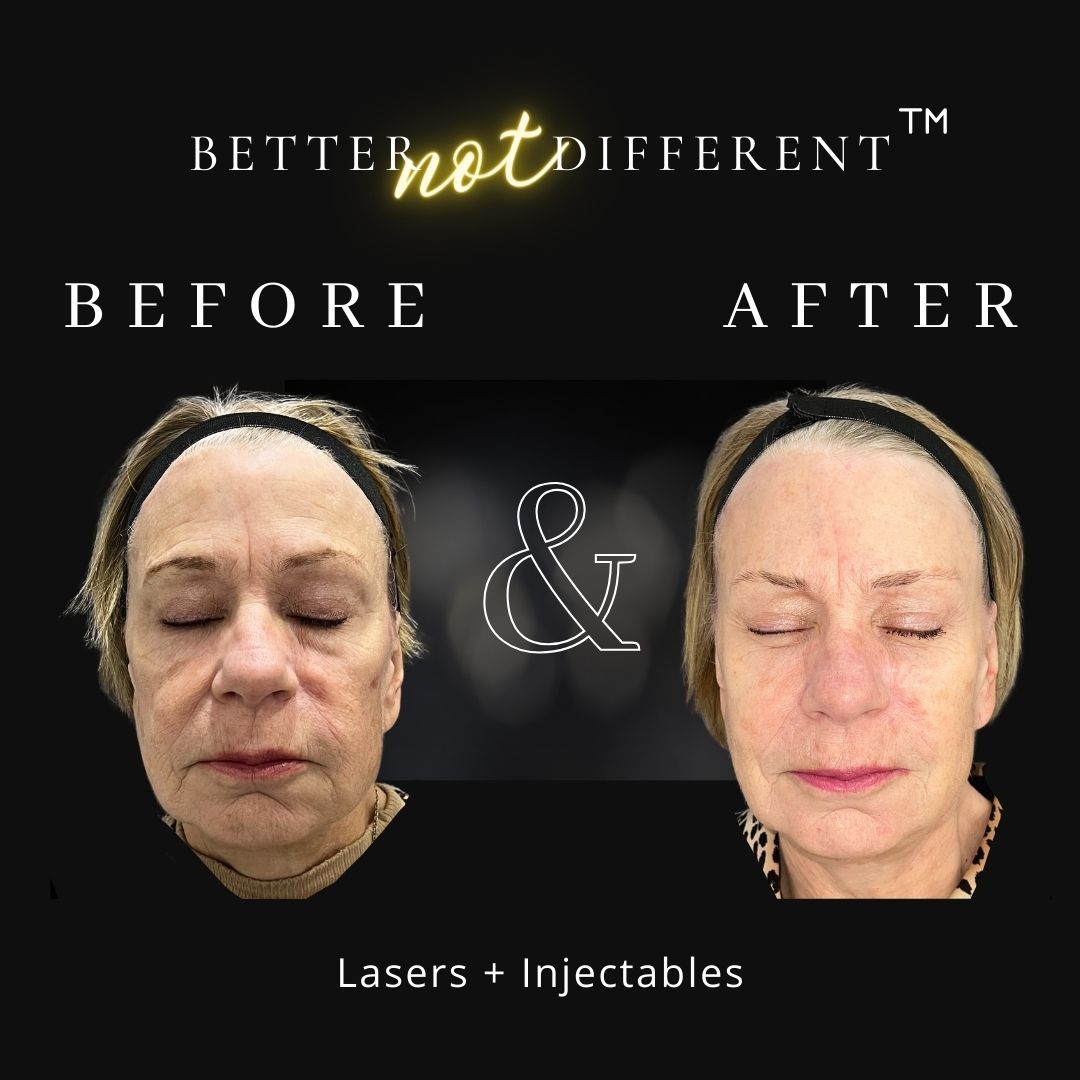 Before and after dermal filler results with Radiesse