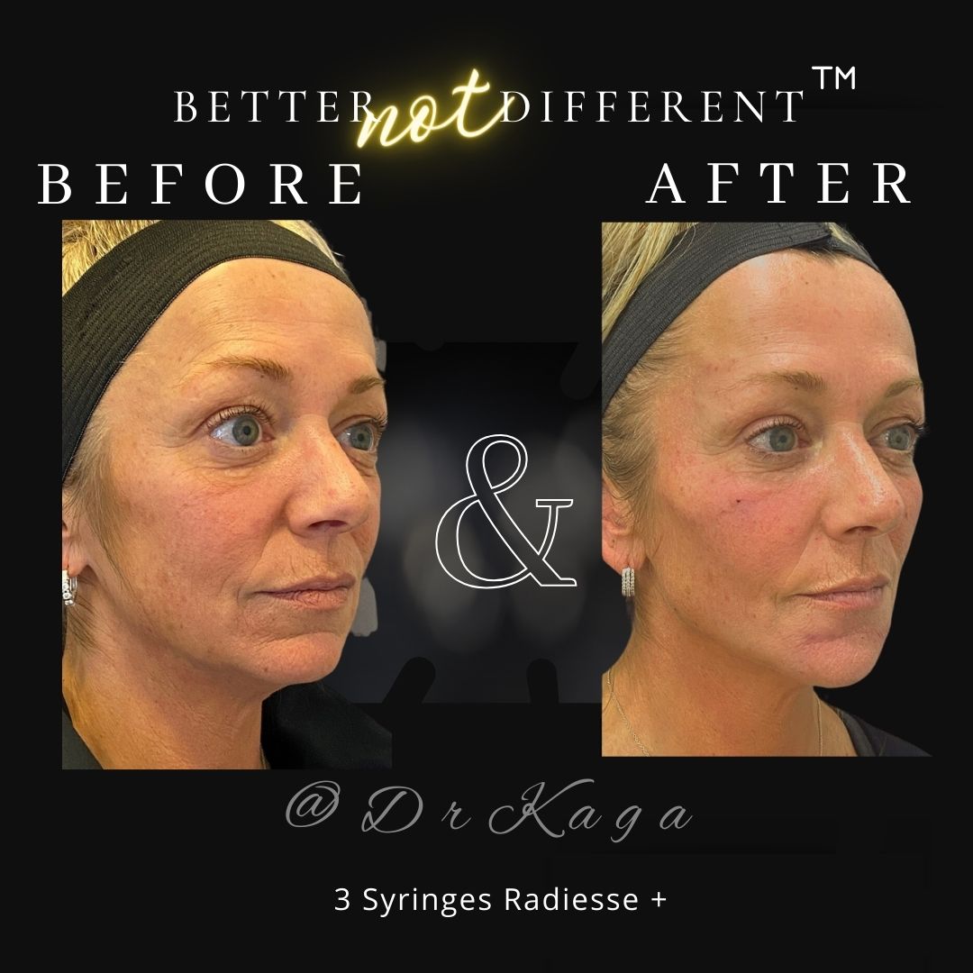 Before and after dermal filler results with Radiesse