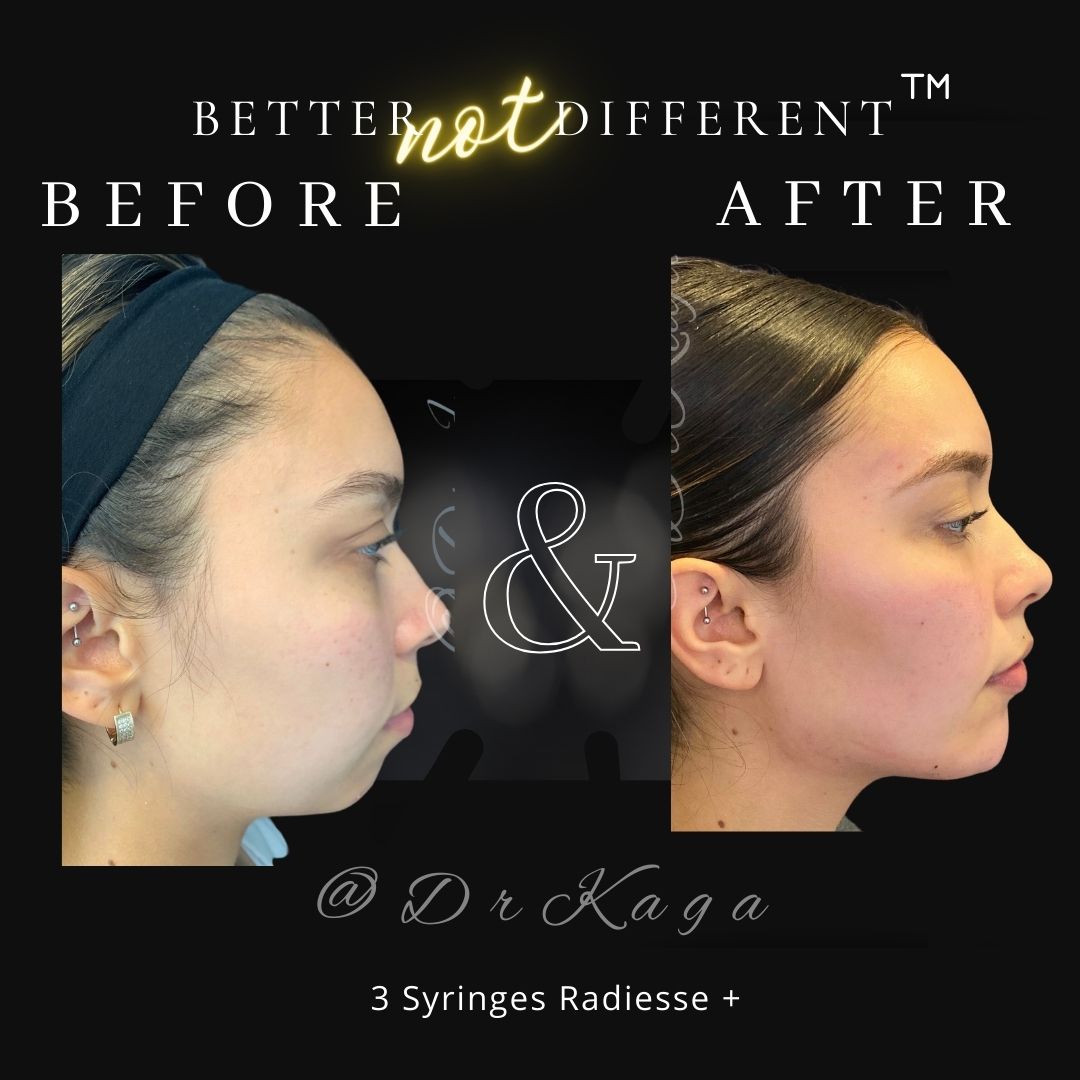 Before and after dermal filler results with Radiesse