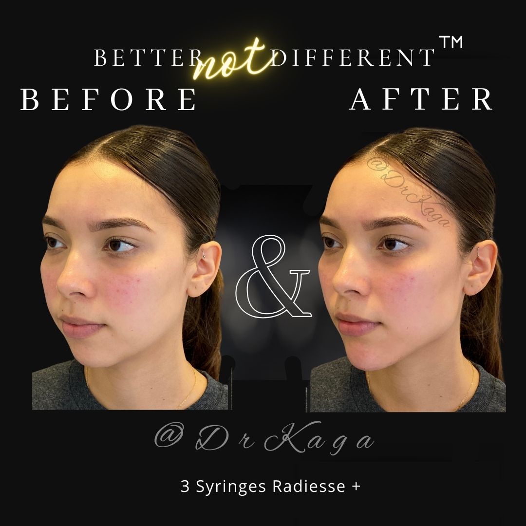 Before and after dermal filler results with Radiesse