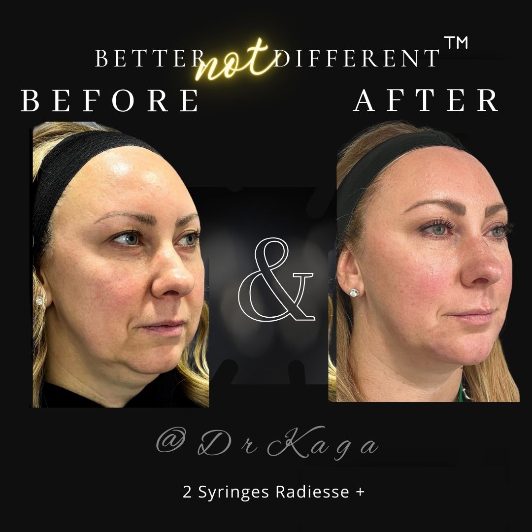 Before and after dermal filler results with Radiesse