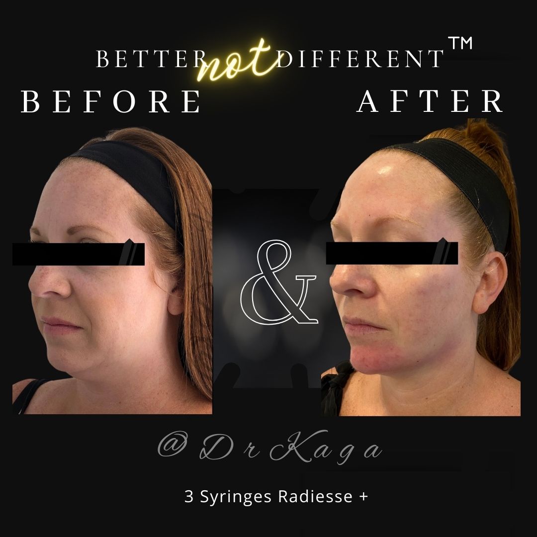 Before and after dermal filler results with Radiesse