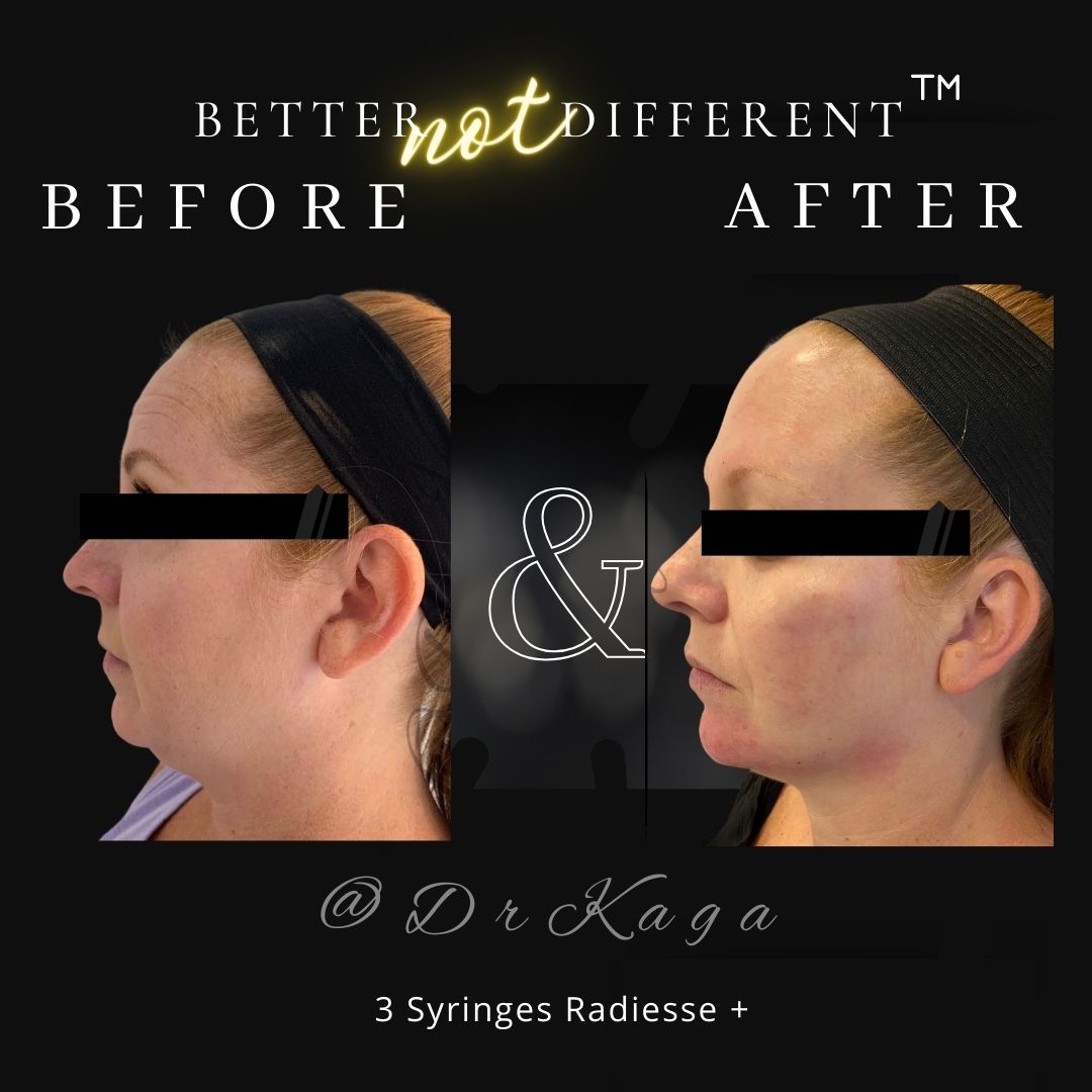 Before and after dermal filler results with Radiesse