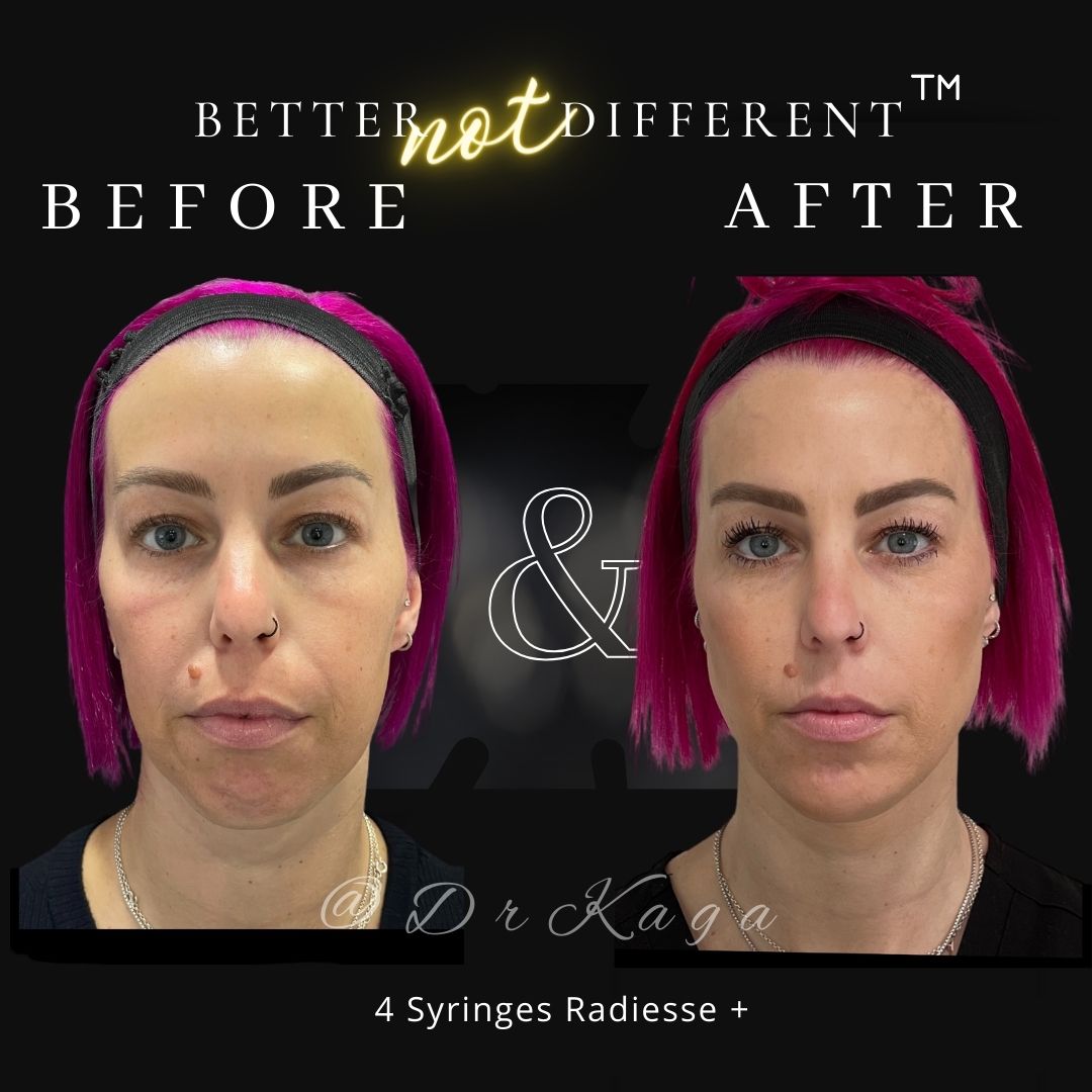 Before and after dermal filler results with Radiesse