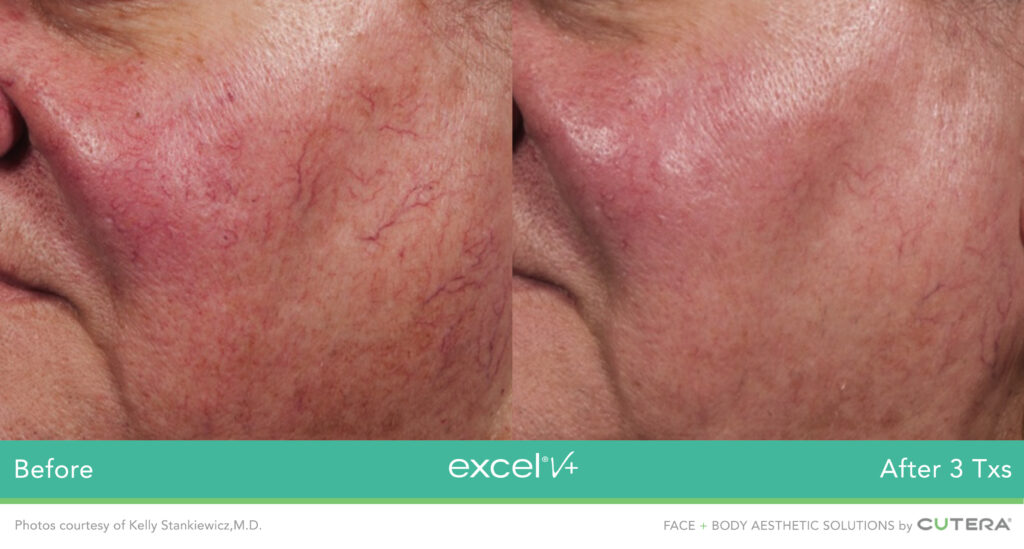 Before and after vein removal treatments