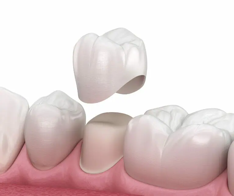 Photo of ceramic crowns