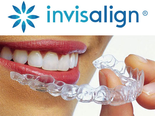 Invisalign® aligners