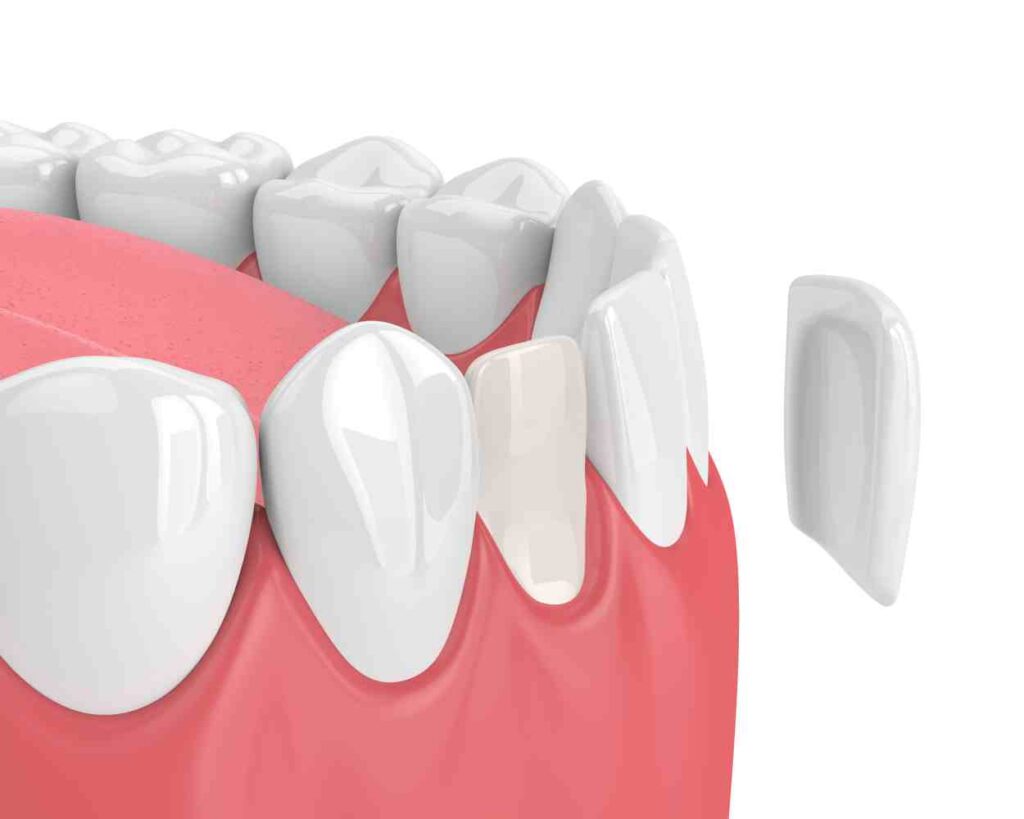 Photo of porcelain veneers