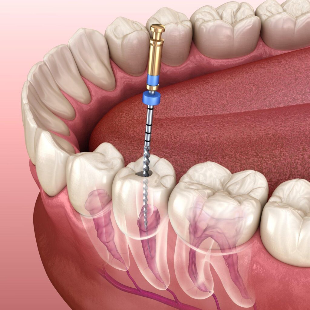 Photo of a simulated root canal