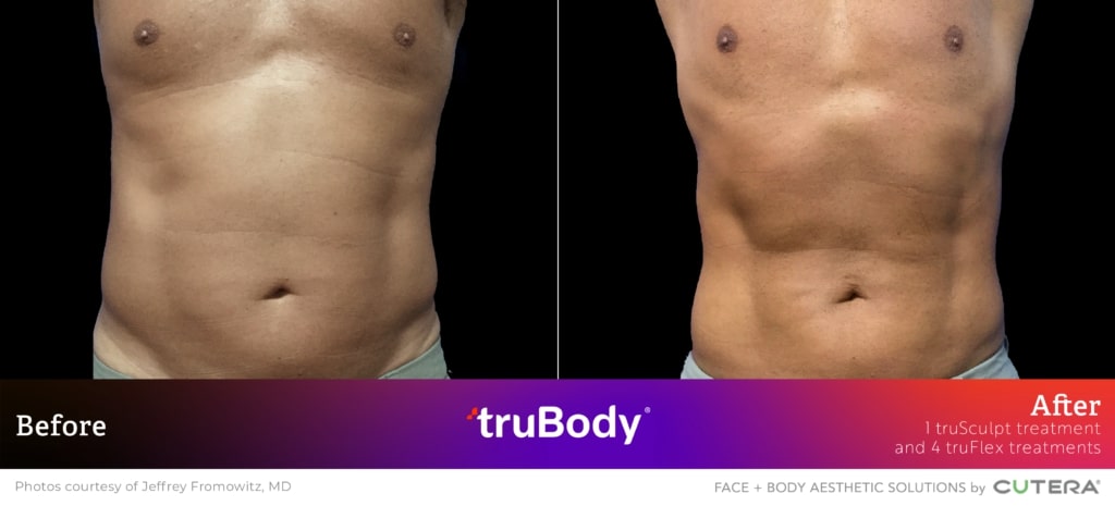 Before and after truBody® results