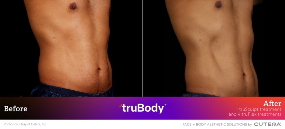 Before and after truBody® results