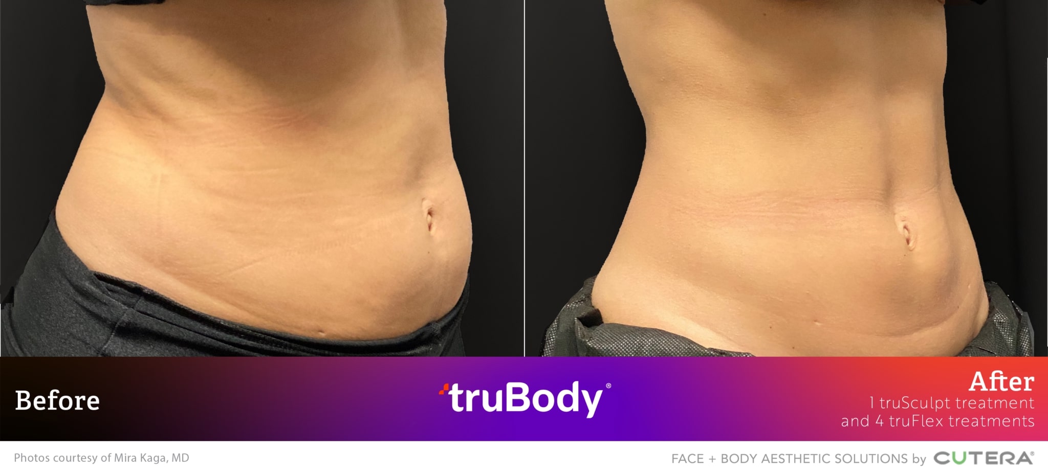 Before and after truBody® results