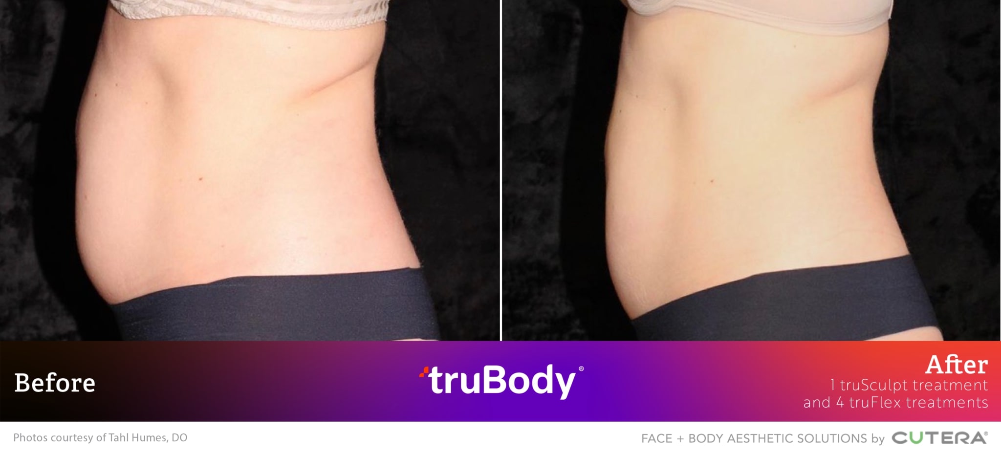 Before and after truBody® results
