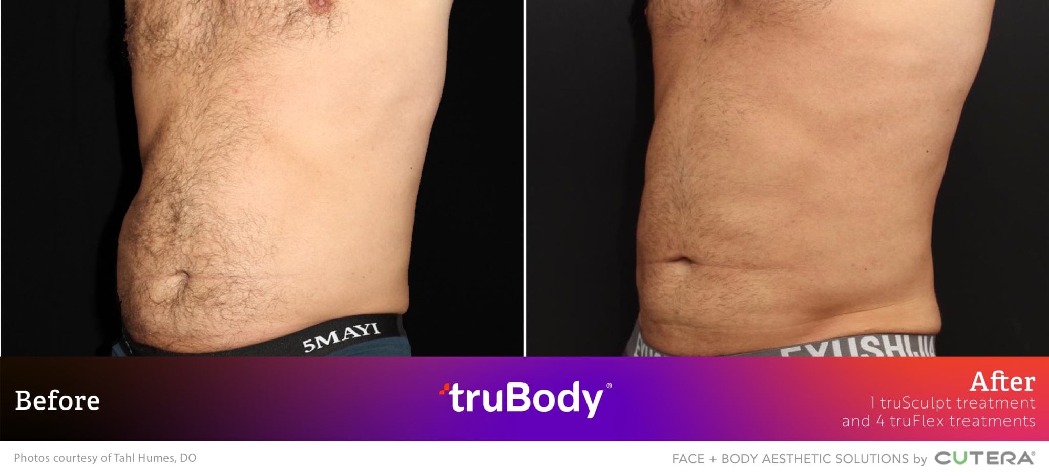 Before and after truBody® results