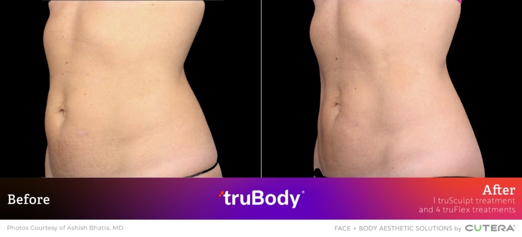 Before and after truBody® results