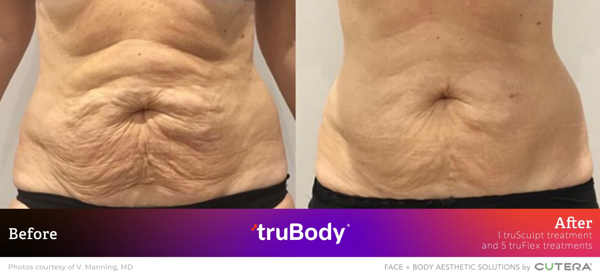 Before and after truBody® results